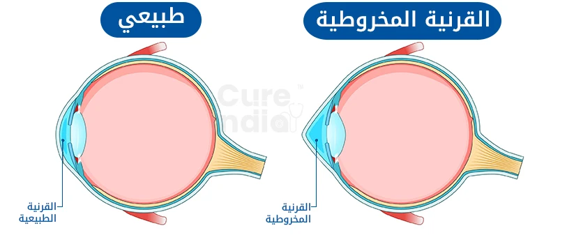 عملية ربط القرنية في الهند